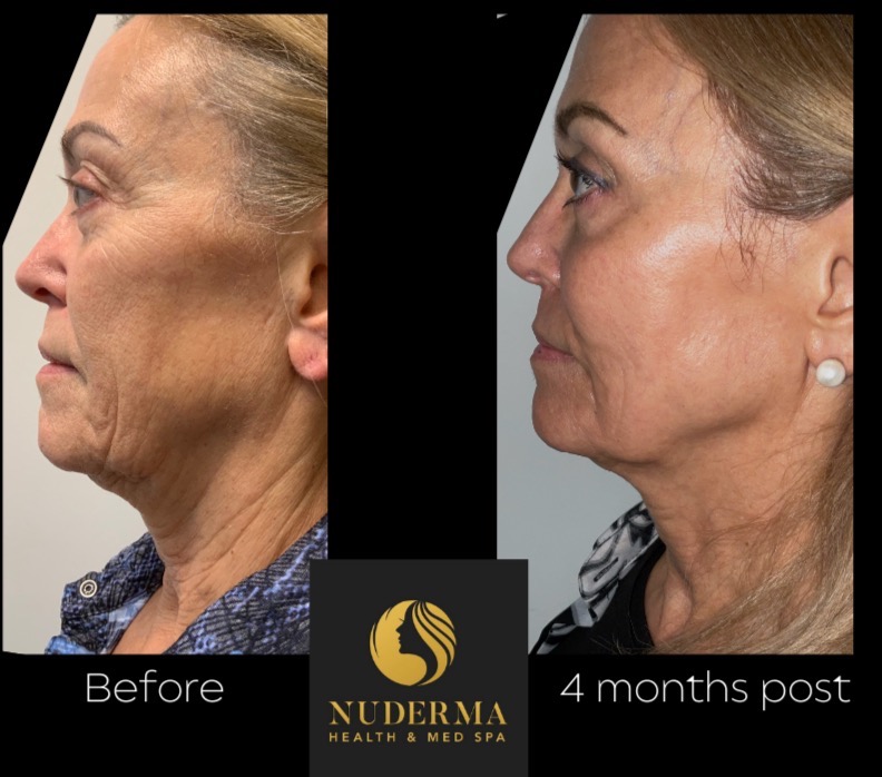CO2 laser resurfacing before-and-after example one