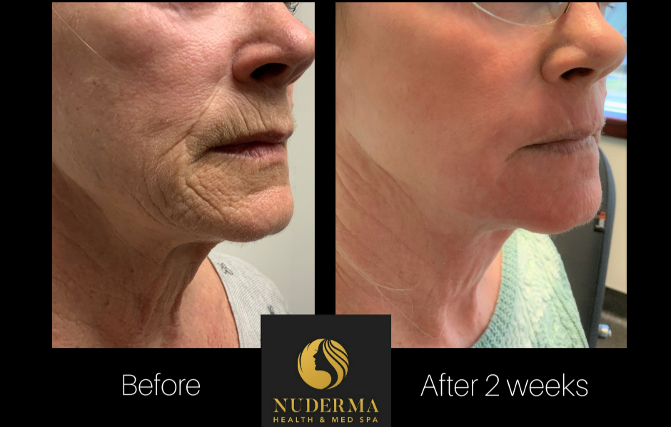 CO2 laser resurfacing before-and-after example two
