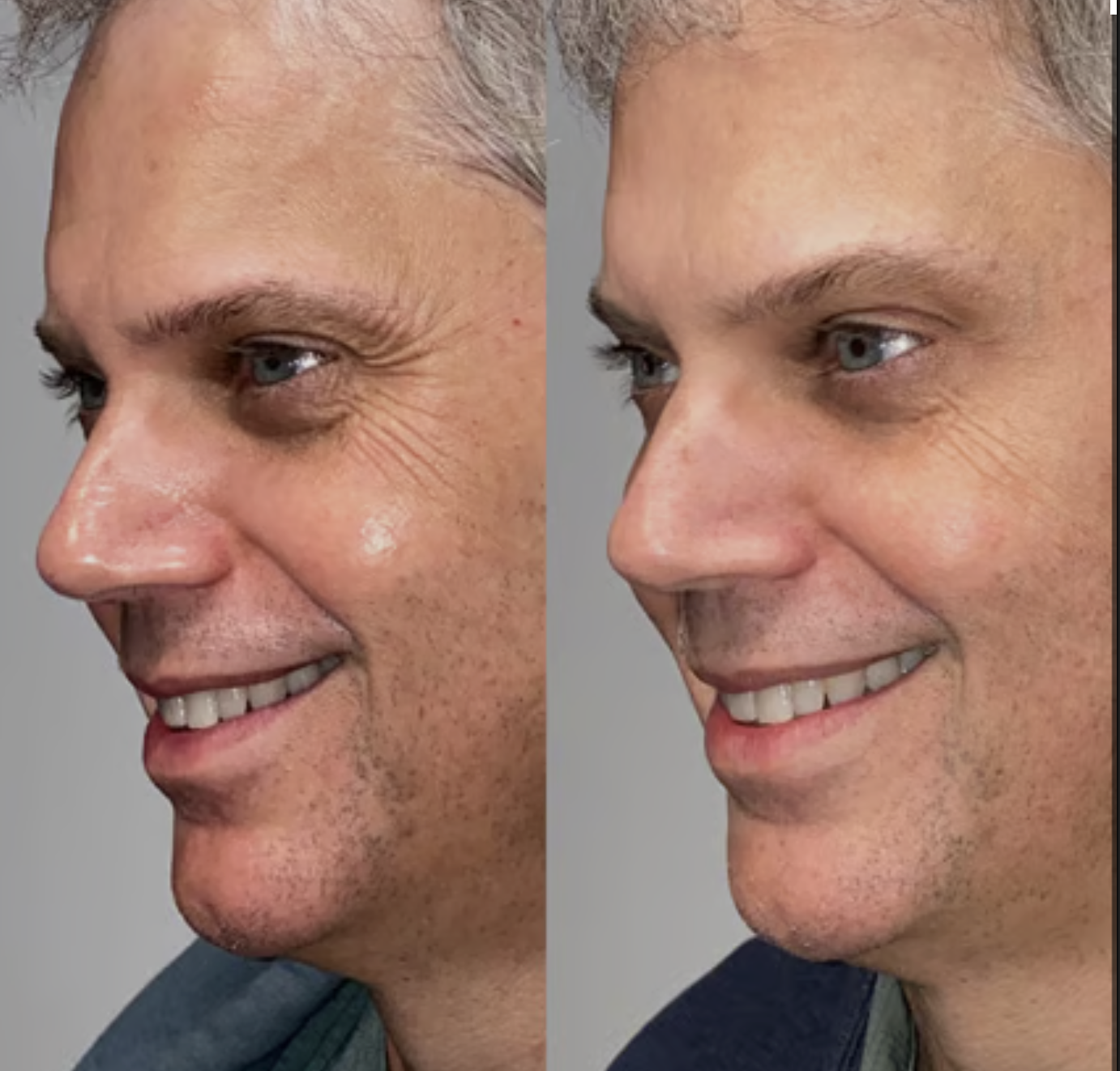 Dysport before-and-after result example 3