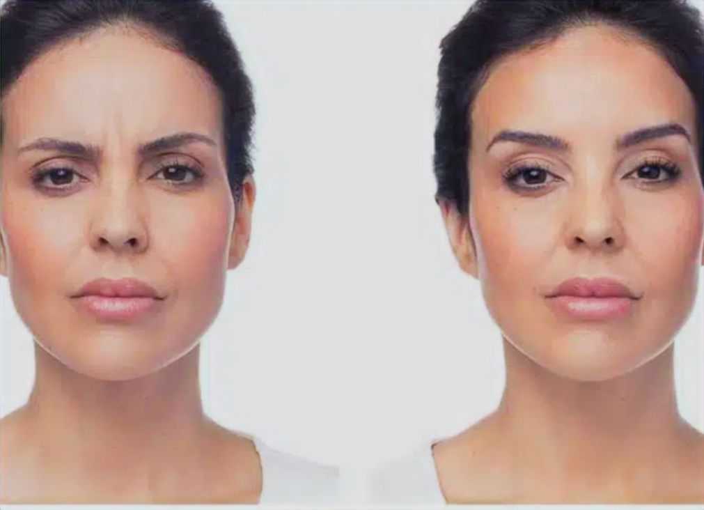 Dysport before-and-after result example 4