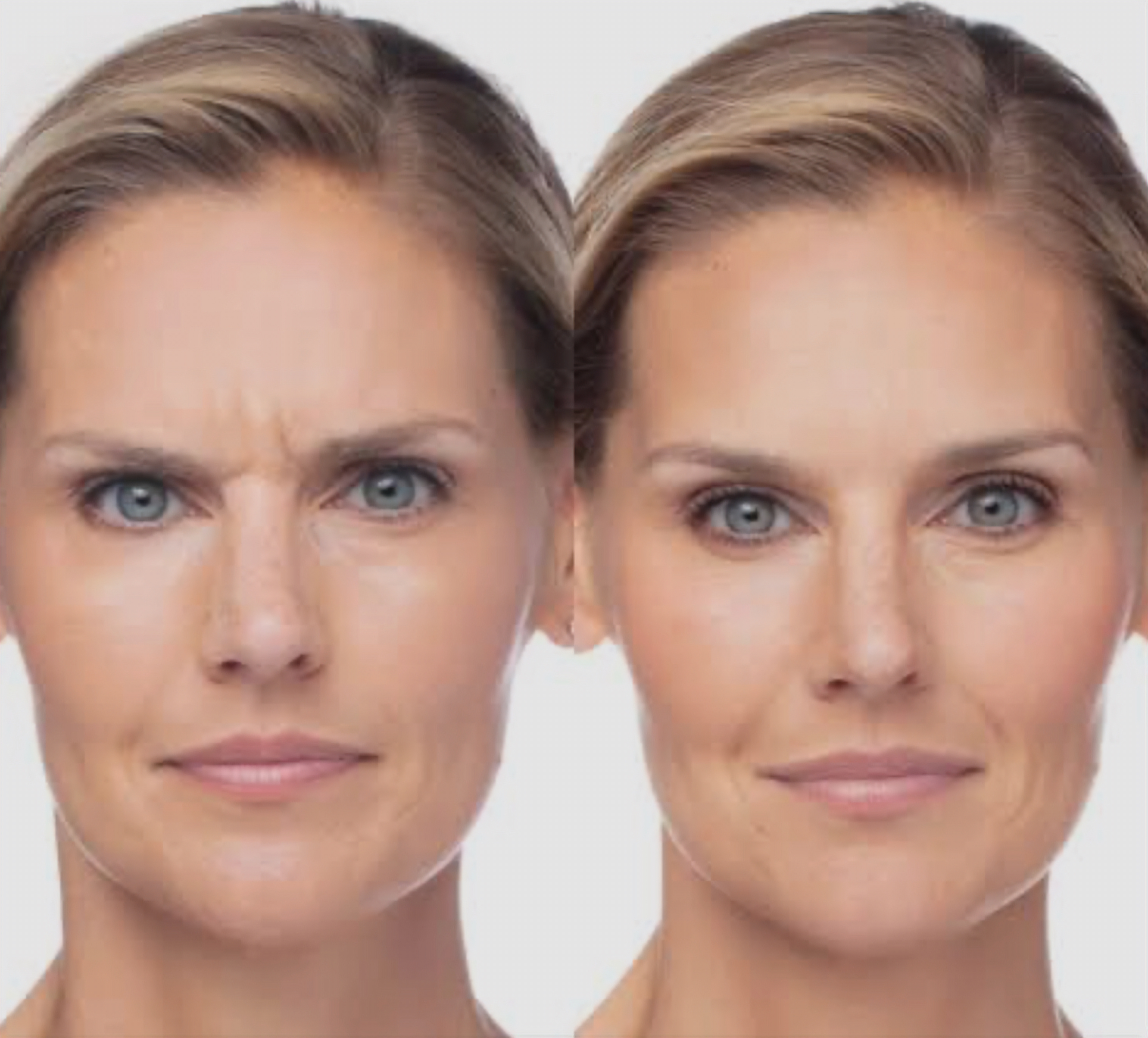 Dysport before-and-after result example 1