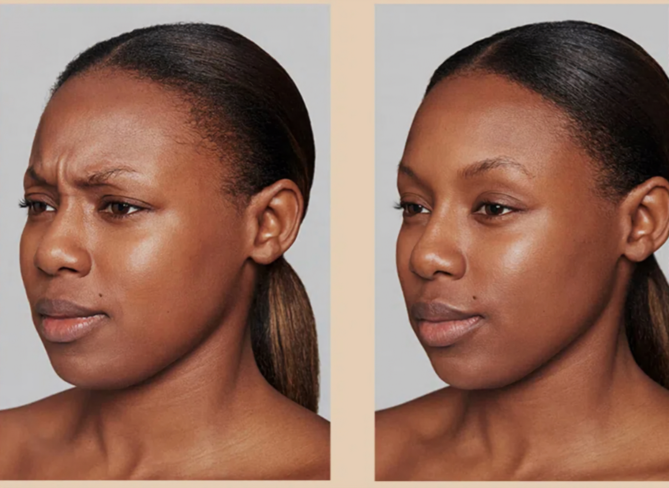 Dysport before-and-after result example 2