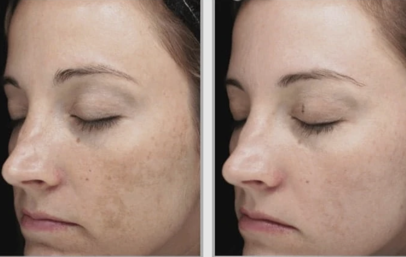 IPL Photofacial before-and-after result example 1