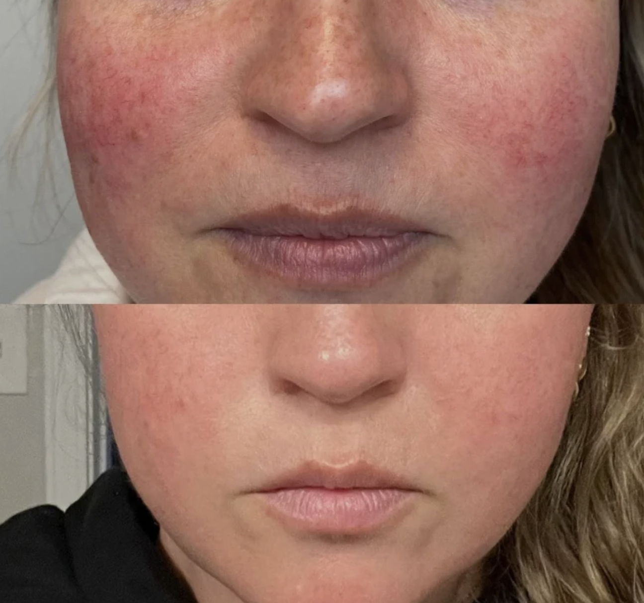 IPL Photofacial before-and-after result example 2