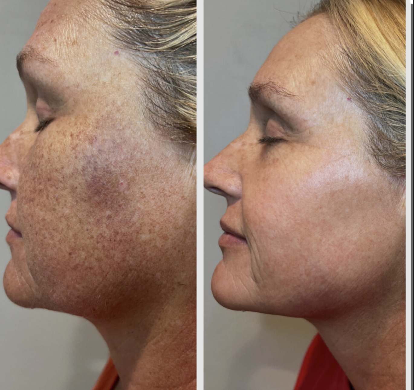 IPL Photofacial before-and-after result example 3