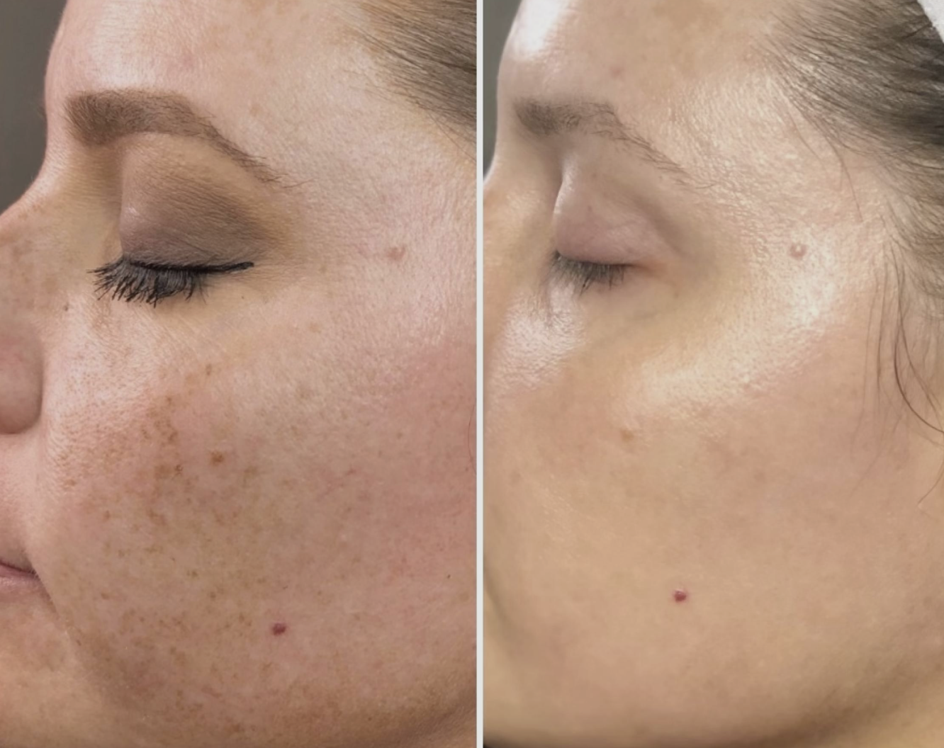 IPL Photofacial before-and-after result example 4