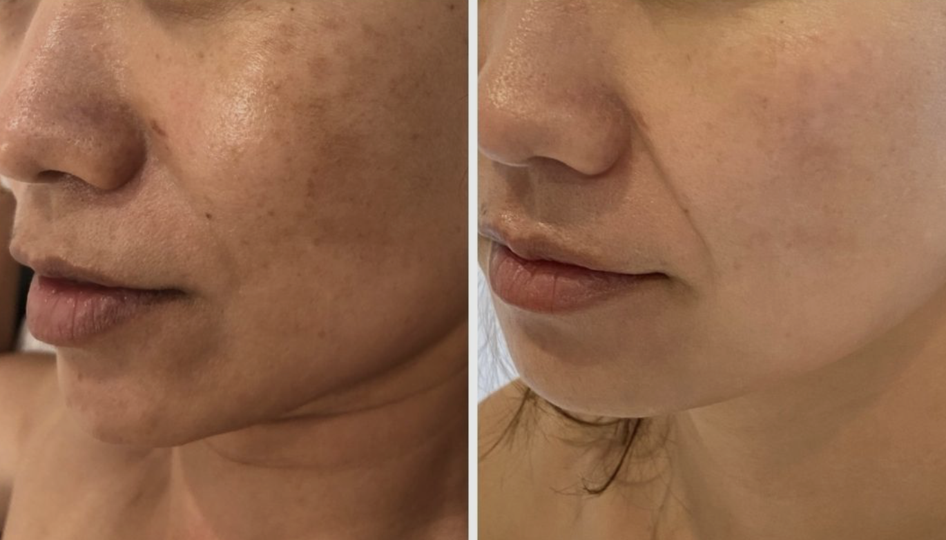 PicoWay Resolve facial treatment comparison from Nuderma’s existing website