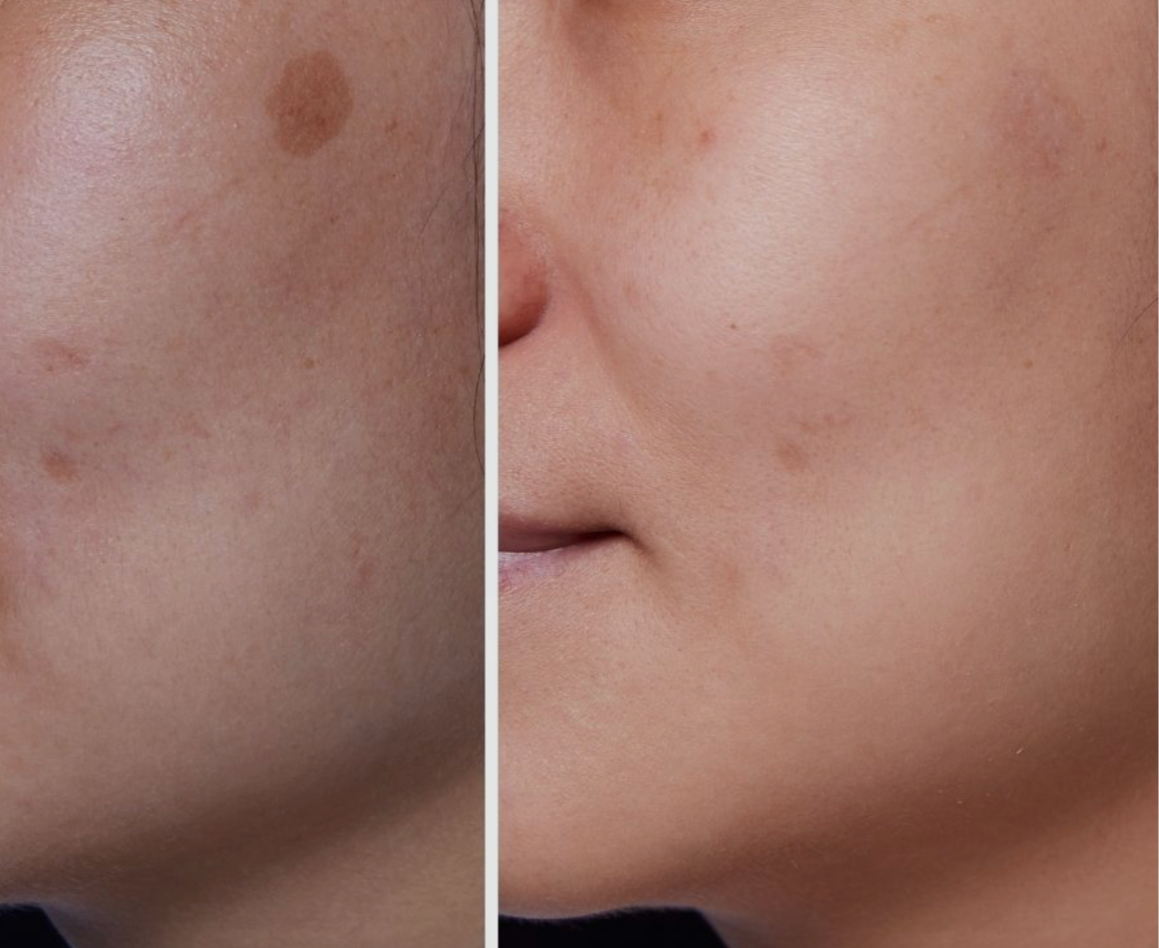 PicoWay Resolve pigmentation treatment comparison from Nuderma’s existing website