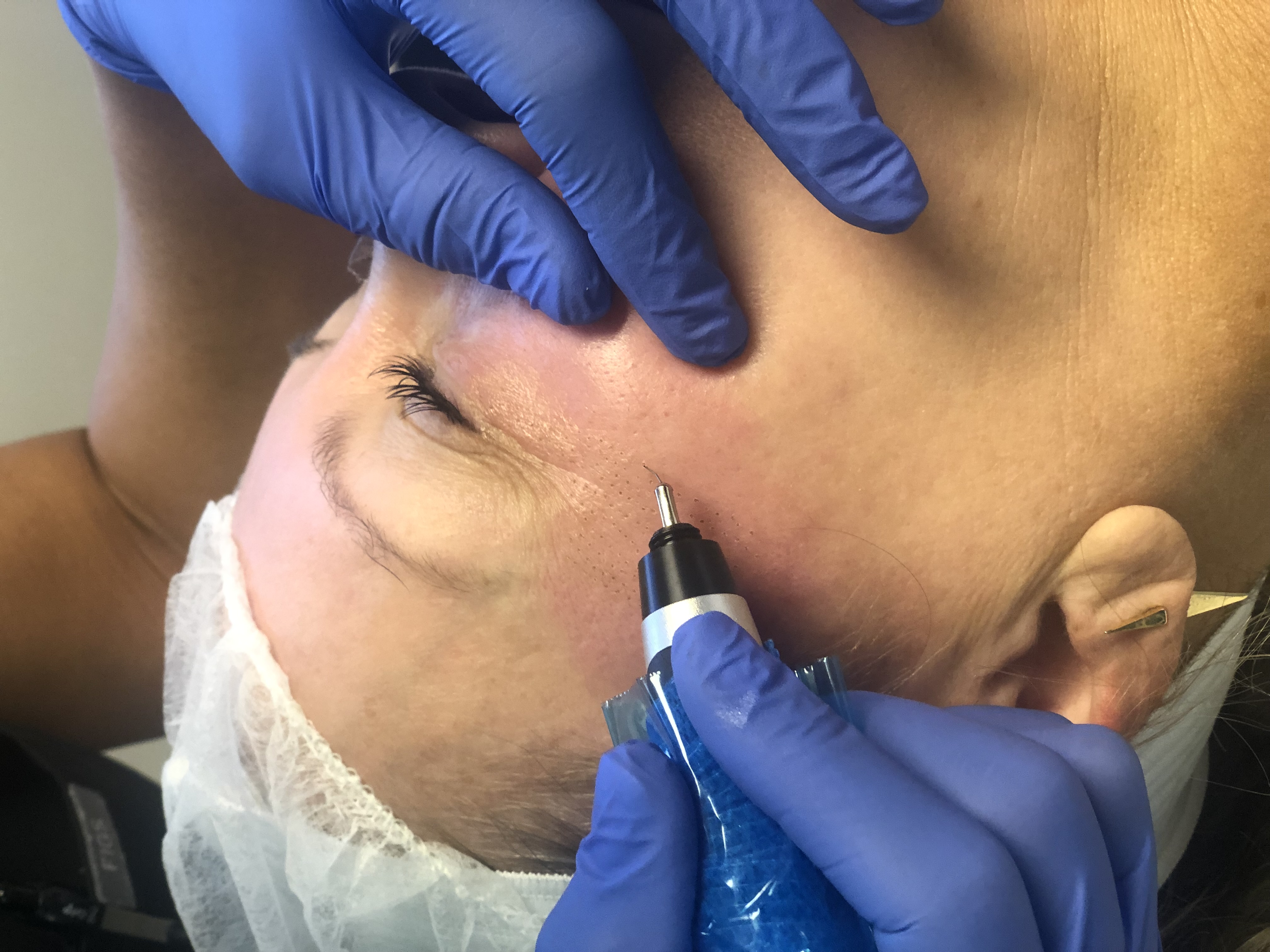 Plasma Pen fibroblast treatment at Nuderma Health & Med Spa