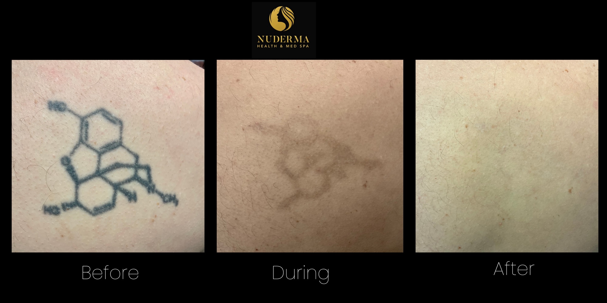 Tattoo appearance before, during, and after a series of laser tattoo removal treatments