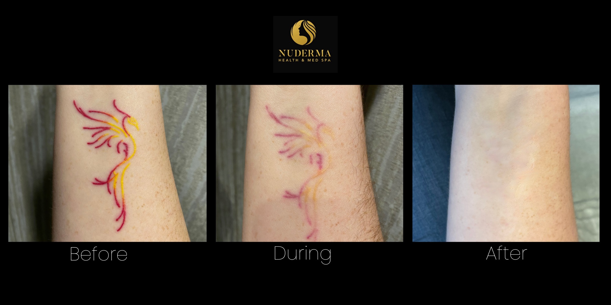 Second tattoo appearance before, during, and after laser tattoo removal treatments